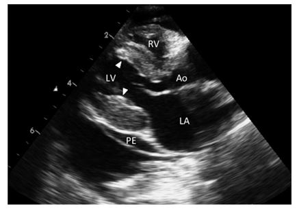 Двумерная эхокардиограмма 7-летней самки кошки короткошерстной породы  с эндомиокардиальной формой рестриктивной кардиомиопатии (РКМП)